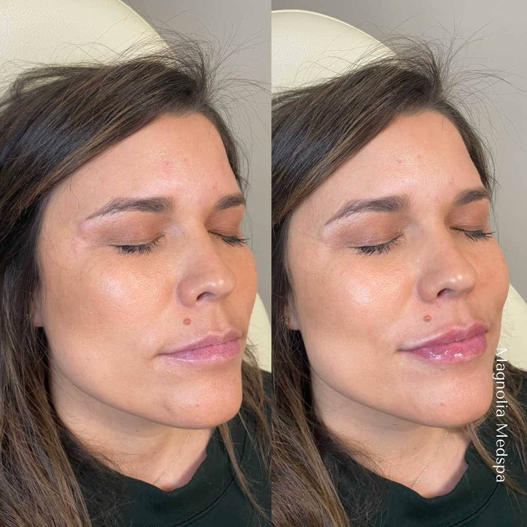 Dermal Filler