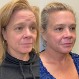 Dysport & Botox